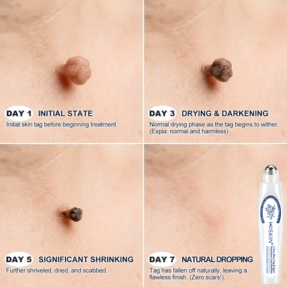 HISKIN®👩‍⚕️ 7-Tage-Hautmakel- & Hautanhängsel-Entferner Schmerzfreier Rollerball-Stift zur schonenden Entfernung von Hautanhängseln und Hautflecken – narbenfrei